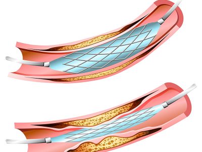 spontaneous-dissection-of-left-anterior-descending-coronary-artery-case-report
